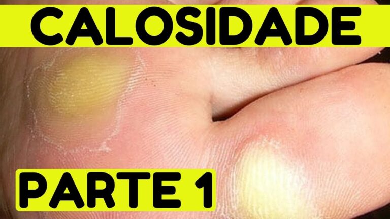 Curso sobre Calosidade Plantar: Guia Completo e Pr&aacute;tico